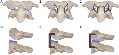 A novel surgical management for pediatric patients with irreducible atlantoaxial dislocation: Transoral intraarticular cage distraction and fusion with C-JAWS staple fixation